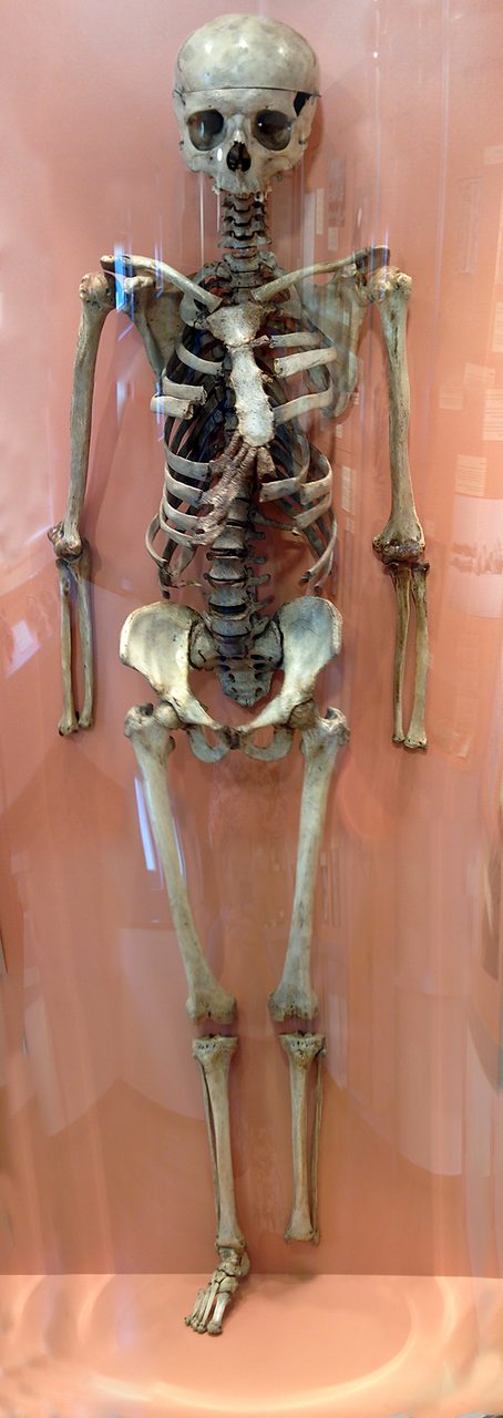 An articulated human skeleton mounted upright behind glass in a museum. The mount is partial and worked: both hands and the left foot are missing, the mandible is absent, the skull cap has been sawn into a removable calotte, the front ends of many ribs are cut short, and dried tissue still adheres to the sternum.