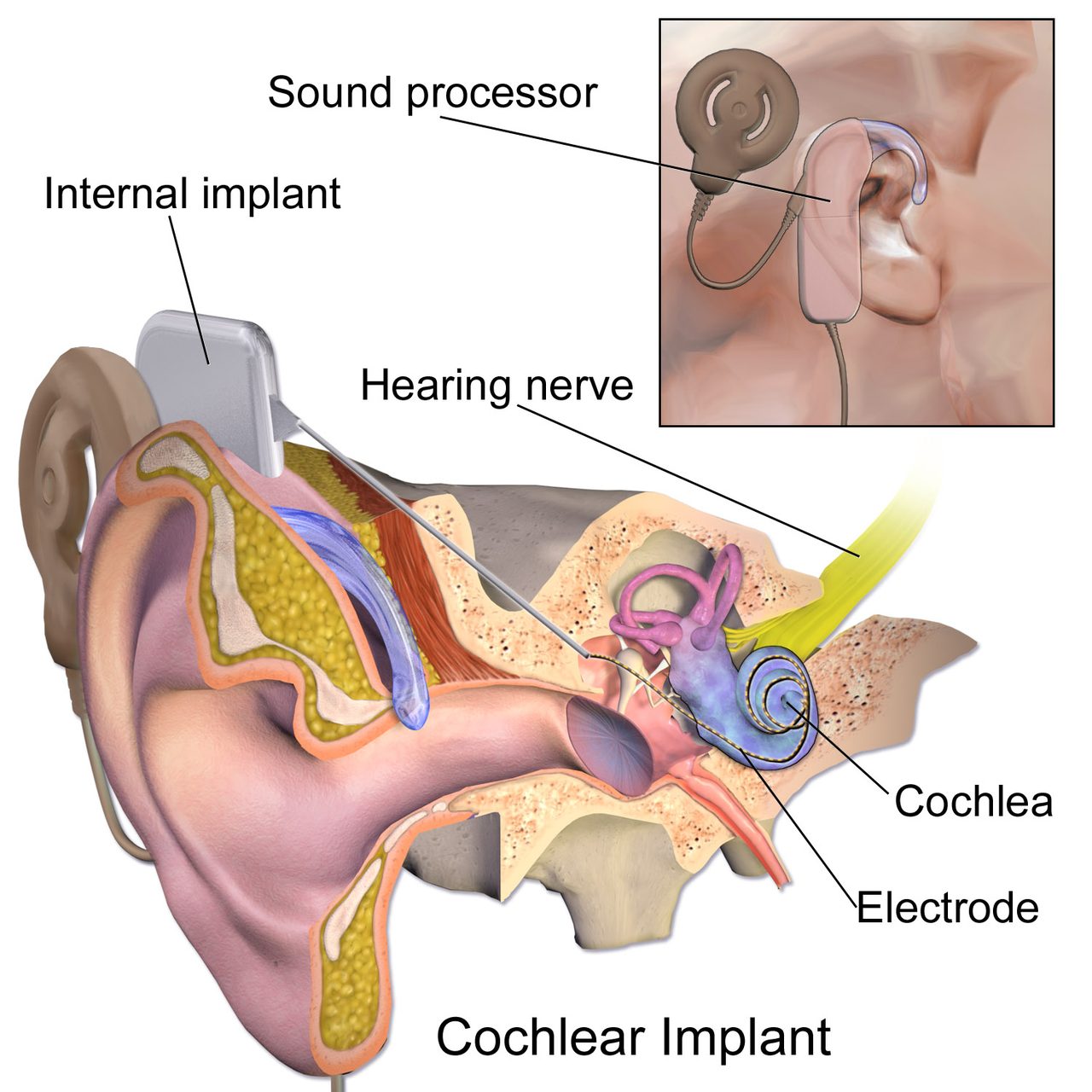 A labeled medical diagram showing the external processor, internal receiver, and electrode array of a cochlear implant system