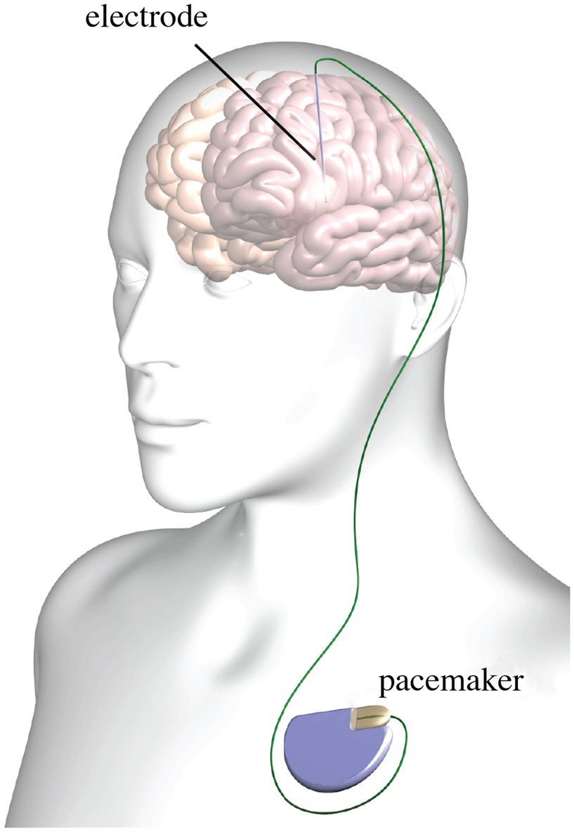A labeled diagram showing a deep brain stimulation electrode placed in the brain, connected by a lead to a pulse generator implanted in the chest