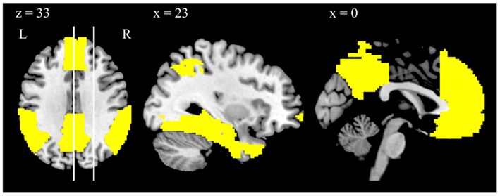 A scientific brain diagram with a highlighted network region and marked slice positions