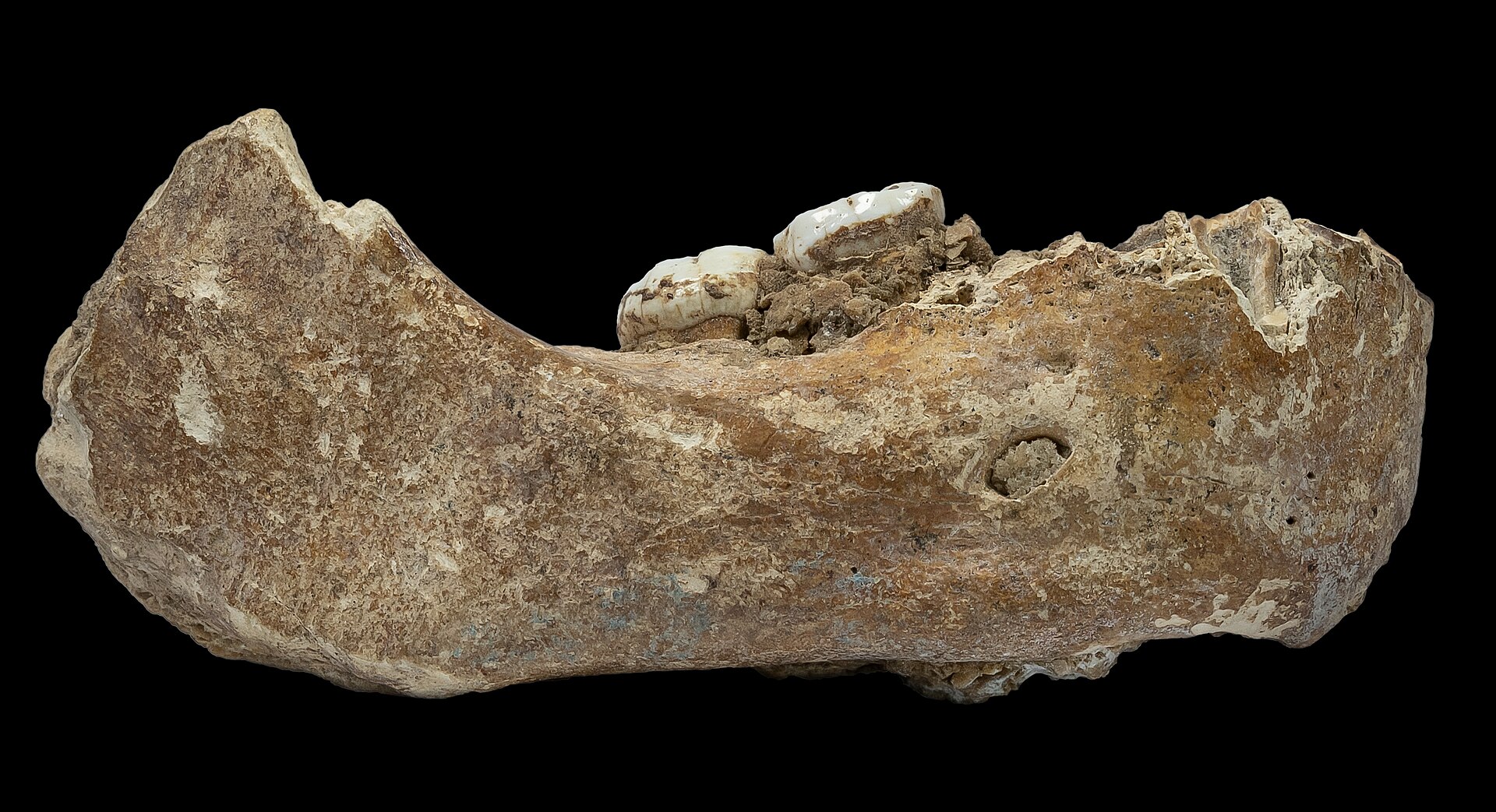 A specimen photograph on pure black. A heavy jawbone fragment in side view, mineral-stained brown and cream and broken at both ends. Two large molars remain in place, their crowns bright white with flattened worn chewing surfaces and dark staining at the roots. A yellowish-white crust of mineral deposit covers parts of the bone and packs the space around the teeth. A round opening sits in the lower centre-right of the body, and faint bluish-grey staining shows along the lower edge.
