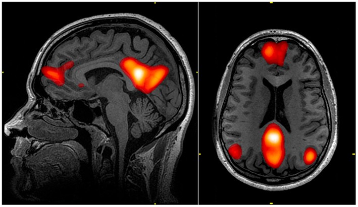 A magnetic resonance imaging scan of a brain with the regions of the default mode network highlighted