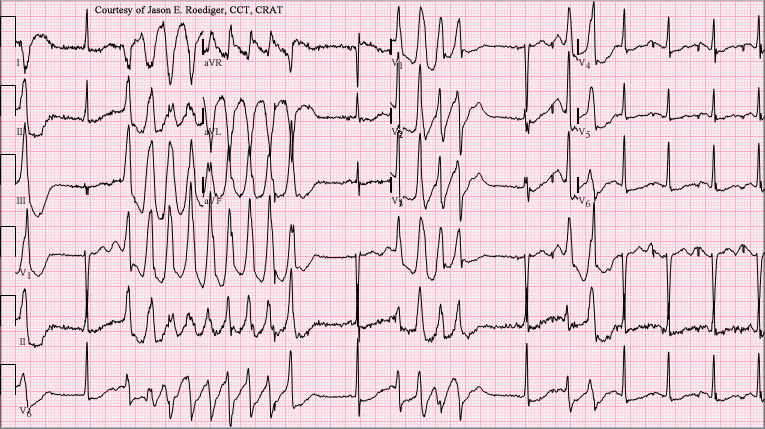 A twelve-lead electrocardiogram on pink grid paper: six rows of trace with small lead labels, in which a few beats followed by long flat stretches give way to a run of tall, broad, rounded complexes of continuously varying height