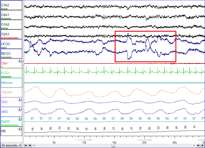 A screenshot of a polysomnogram showing the multi-channel signal traces recorded during REM sleep, including an eye-movement channel