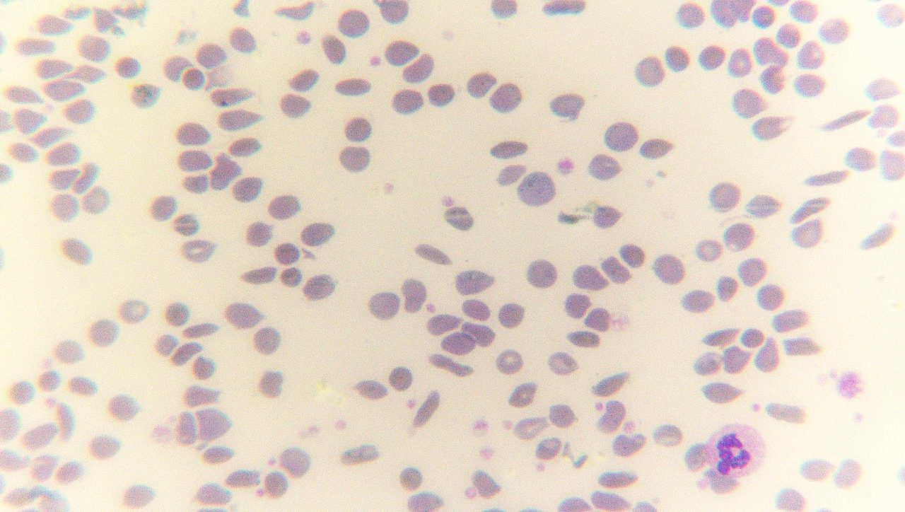 A microscope image of a stained blood film showing distorted, elongated red blood cells among normal round ones