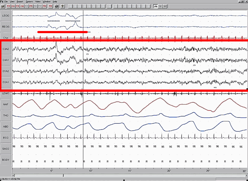 A polysomnography screenshot with the two eye channels at the top showing large matched deflections underlined in red, a flat low-amplitude chin channel below them, a red rectangle around four EEG channels showing small fast irregular activity, and breathing, heart and oxygen channels beneath