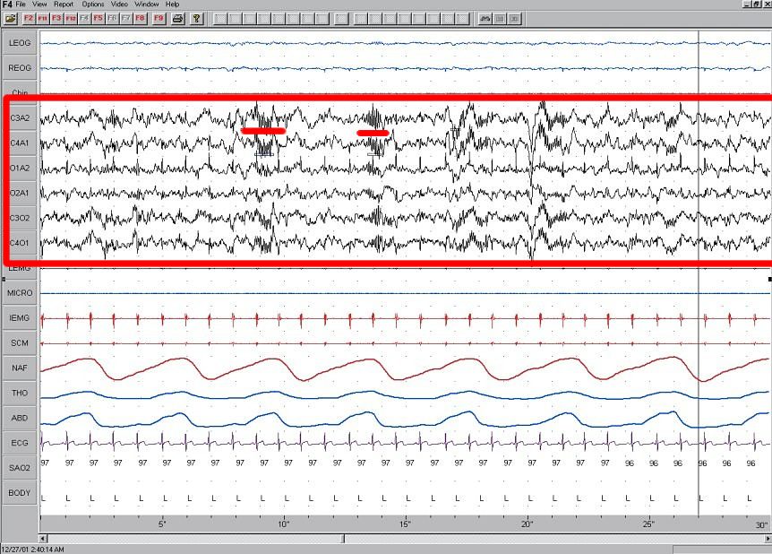 A screenshot of clinical polysomnography software showing about twenty labelled traces stacked down the screen, eye and chin channels at top, a red rectangle drawn around six EEG channels with two short red underlines inside it, then breathing, heart and oxygen channels below, over a thirty second timeline