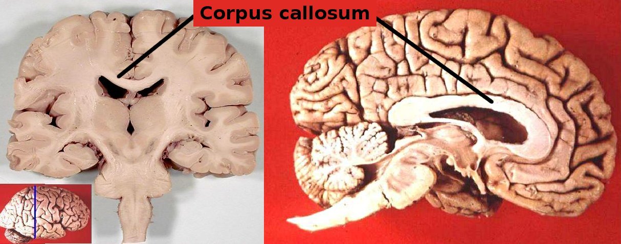 A labeled two-panel anatomical diagram showing the location of the corpus callosum in the human brain, a coronal cross-section on the left and a sagittal midline view on the right