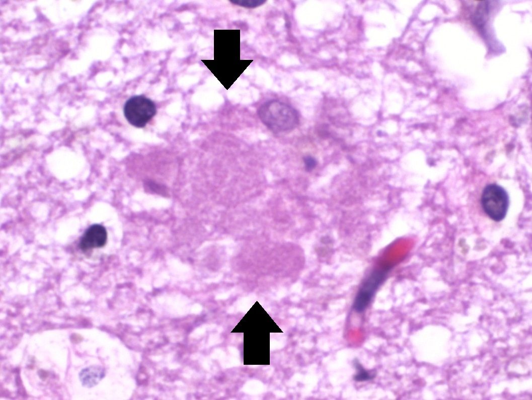 A high-magnification micrograph of brain tissue stained pink and purple, with two solid black arrows drawn onto the image, one above and one below, pointing inward at a rounded mottled mass at the centre