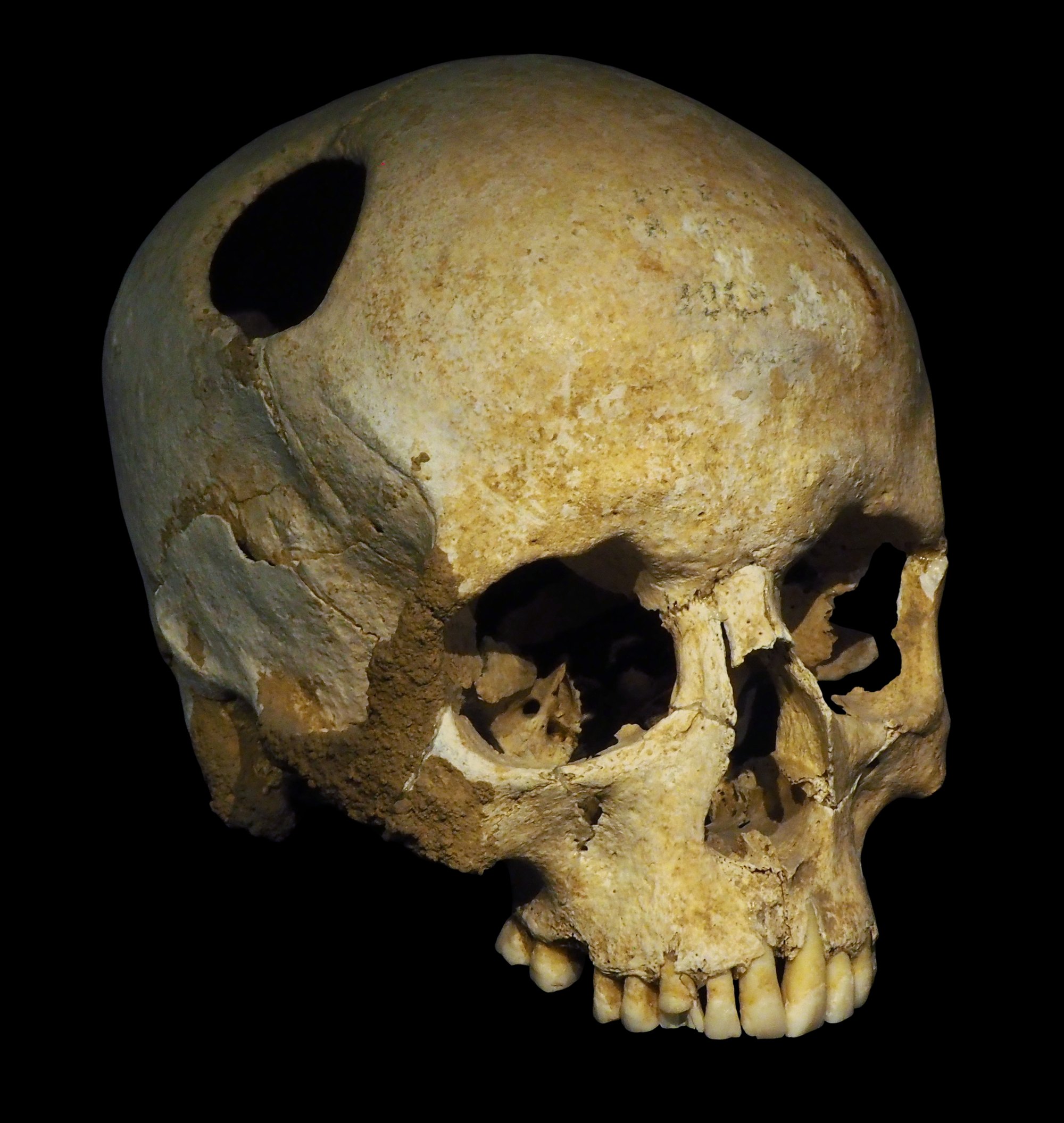 A prehistoric human skull photographed against a black background, warmly lit, showing a clean round opening cut into the upper left of the cranium with smooth, healed-looking margins; the jaw and teeth are intact